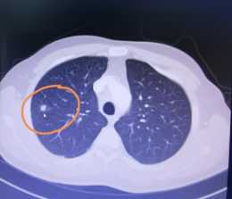 劉懿博士說肺癌（二八一三）1cm肺結節沒當回事，兩年後淋巴轉移